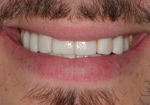 Example Of Porcelain Veneers Made In Costa Rica porcelain veneers made outside USA