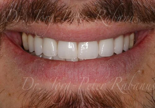 porcelain veneers made in San Francisco