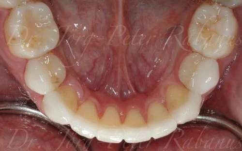 Dental Veneers San Francisco dental veneers san francisco