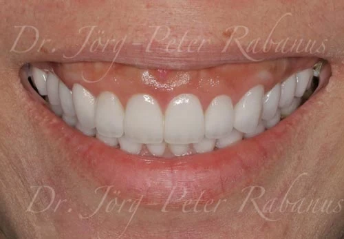 new smile with porcelain veneers