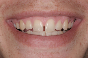 spaces between teeth before smile design with porcelain veneers