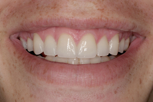 Spaces between teeth eliminated by smile design with porcelain veneers