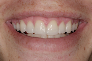 Diastemas between teeth eliminated with porcelain veneers Spaces between teeth eliminated by smile design with porcelain veneers