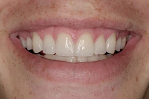 Spaces between teeth eliminated by smile design with porcelain veneers