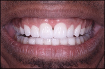 after cosmetic dental procedure