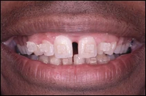 before cosmetic dental procedure