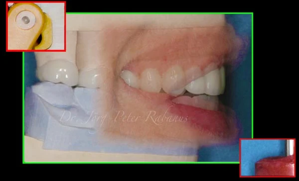 Smile Design Dental Articulator smile design dental articulator