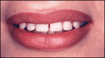 spaces before porcelain veneers