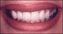 spaces after porcelain veneers