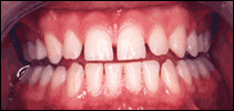 spaces before cosmetic dentist