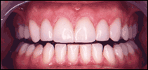 spaces after cosmetic dentist
