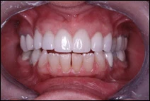 cosmetic porcelain bridge placed