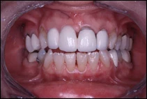 before cosmetic porcelain bridge