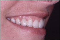 straighter teeth after smile makeover