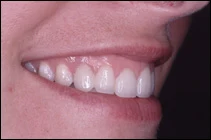 straighter teeth after smile makeover