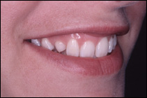 crowded teeth before smile makeover
