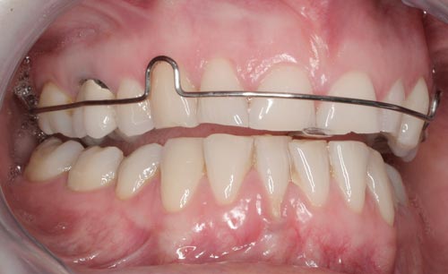 Deprogrammer For Worn Teeth worn teeth deprogrammer