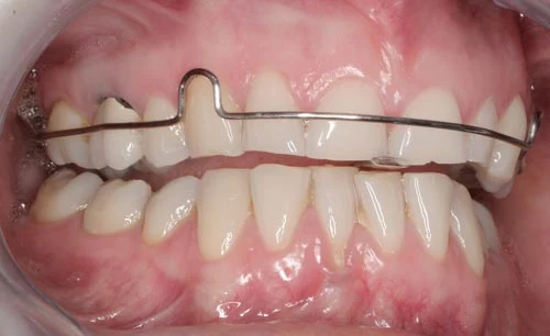 Deprogrammer For Worn Teeth worn teeth deprogrammer