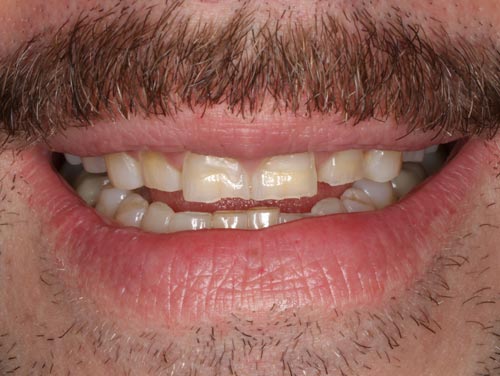 Worn Teeth For Porcelain Veneers worn teeth porcelain veneers