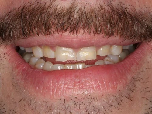 worn teeth porcelain veneers