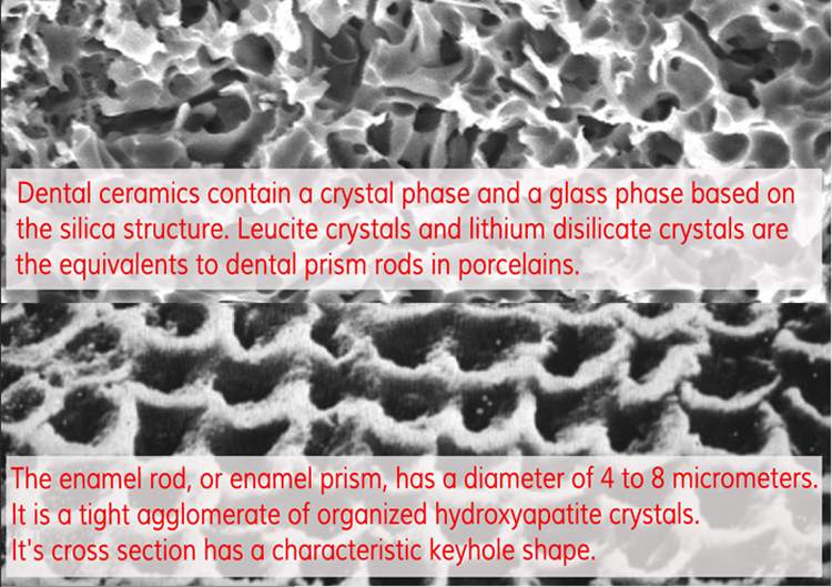 dental enamel porcelain veneers comparison1