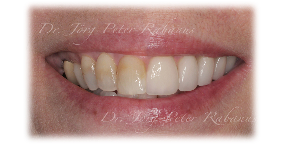 dental enamel compared to porcelain