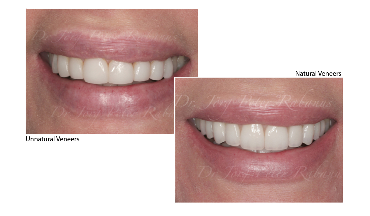 porcelain veneers look natural