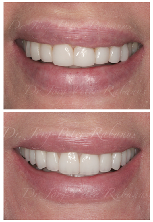 natural porcelain veneers