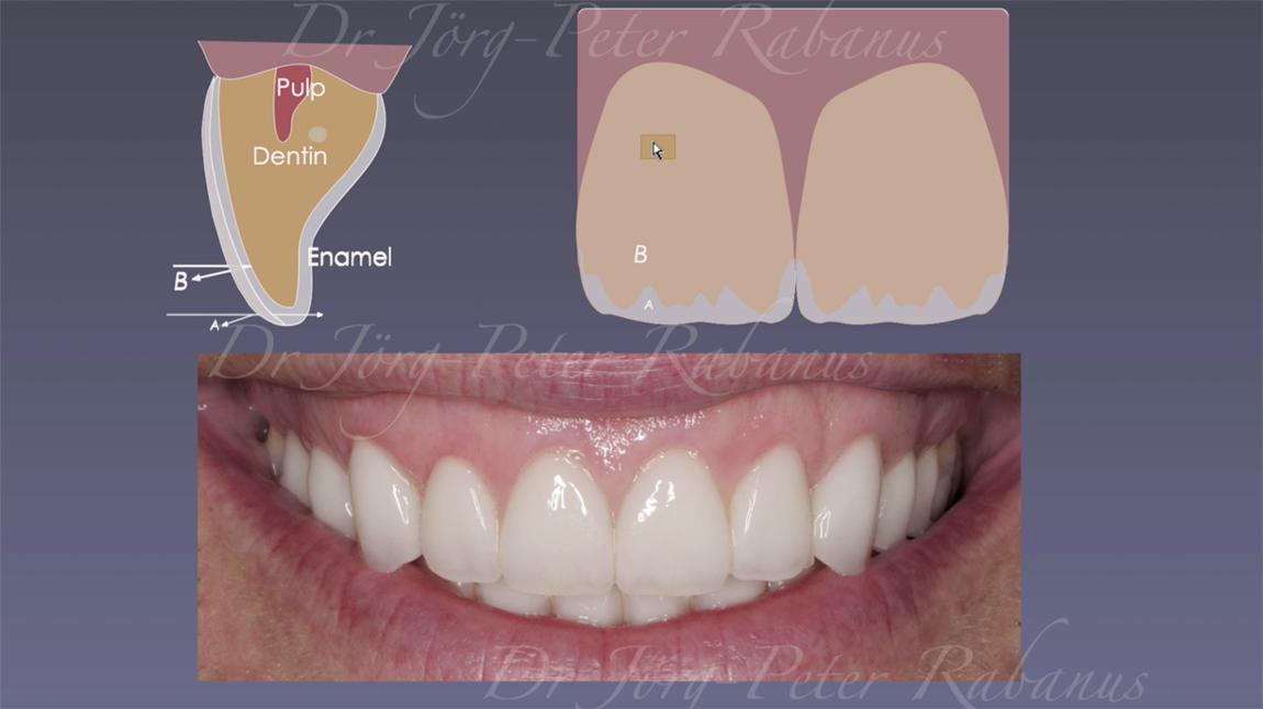 thin porcelain veneer bonded to enamel