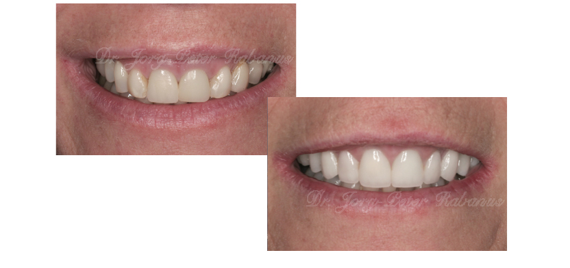 Porcelain Veneers, Smile Design, Gum Lift