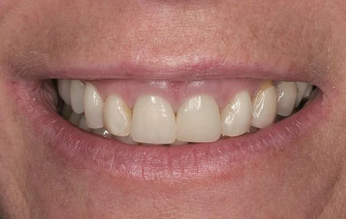 alt="before porcelain veneers for gummy smiles"