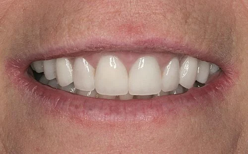 porcelain veneers san francisco for gummy smiles