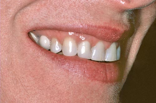 worn teeth before smile rejuventation right