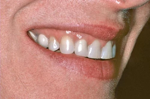 worn teeth before smile rejuventation right