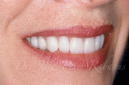 smile makeover of worn teeth right side