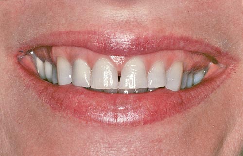 worn teeth before smile rejuventation left