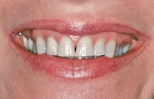 worn teeth before smile rejuventation left