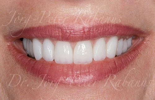 smile rejuvenation of worn teeth left