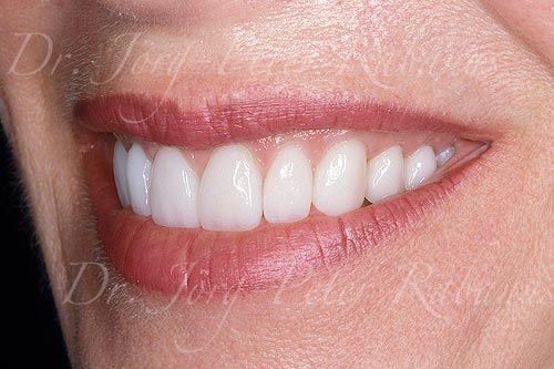 smile rejuvenation of worn teeth