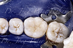 molar after cosmetic filling