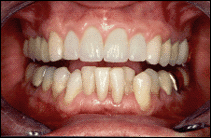 conservative-cosmetic-dentistry-with-bleaching-and-porcelain-veneers-after