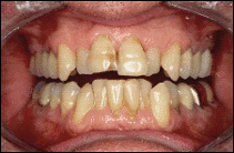 Stained and Misaligned Teeth Before Teeth Whitening Procedure stained and misaligned teeth san francisco