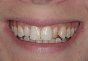 conservative-cosmetic-dentistry-with-bleaching-and-porcelain-veneers-before