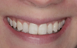 conservative-cosmetic-dentistry-with-bleaching-and-porcelain-veneers-after