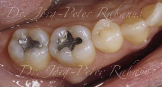 molar before cosmetic filling