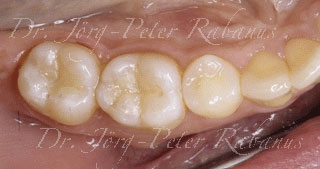 molar after cosmetic filling