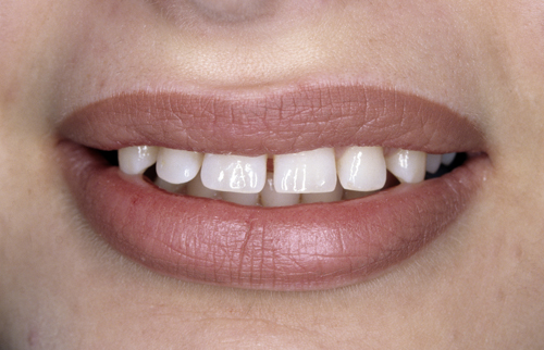 dental-diastemas-are-spaces-between-teeth