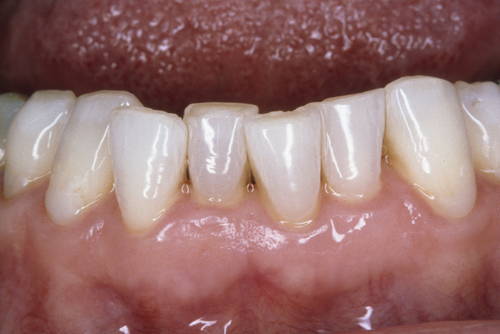 misaligned and crowded lower anterior teeth