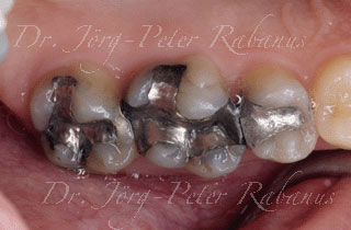 back teeth before placement of porcelain crown