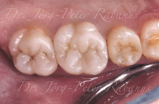 back teeth after placement of porcelain crown